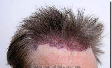 Hair restoration procedure results