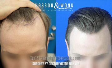 Top view - Before and after hair restoration procedure