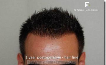 Hair restoration procedure results