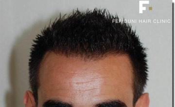 Hair restoration procedure results