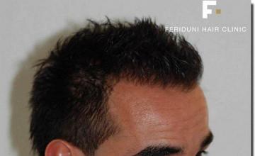 Hair restoration procedure results