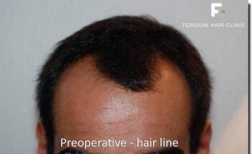 Hair restoration procedure results