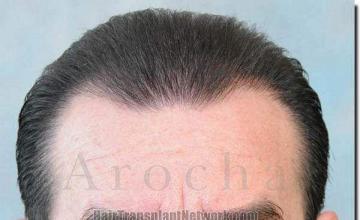 Hair restoration procedure results