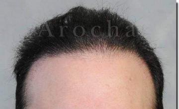 Hair restoration procedure results