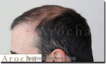 Hair restoration procedure results