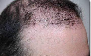 Hair restoration procedure results