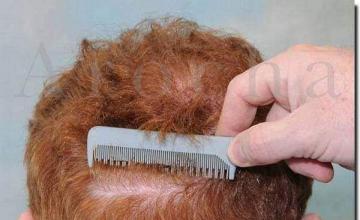 Hair restoration procedure results