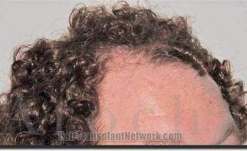 Hair restoration procedure results