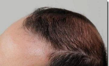 Hair restoration procedure results