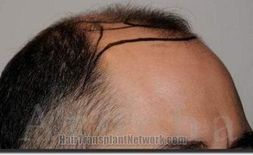 Hair restoration procedure results