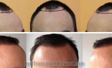 Hair restoration procedure before and after results