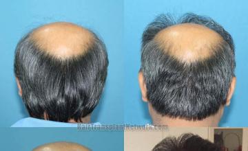 Surgical hair transplantation result photographs