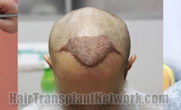 Hair restoration procedure before and after results