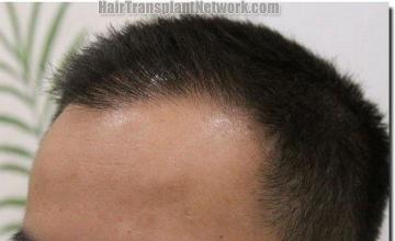 Hair restoration procedure results