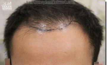 Hair restoration procedure results