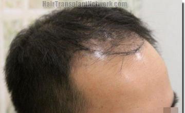 Hair restoration procedure results