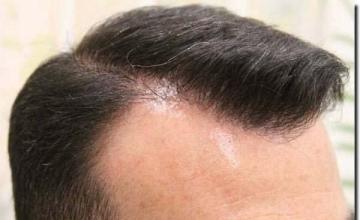 Hair restoration procedure results