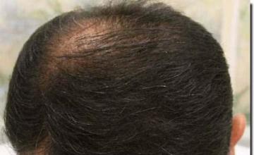 Hair restoration procedure results