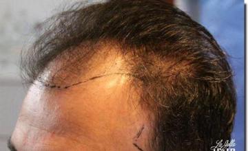 Hair restoration procedure results