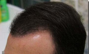 Hair restoration procedure results