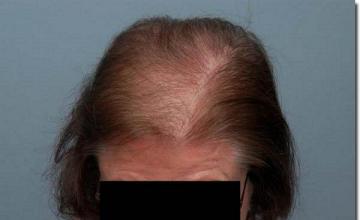 Hair restoration procedure results