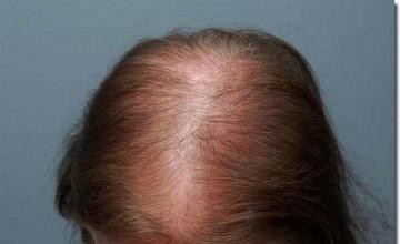 Hair restoration procedure results