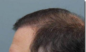 Hair restoration procedure results