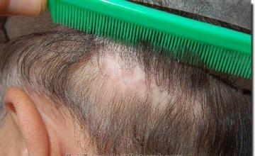 Hair restoration procedure results