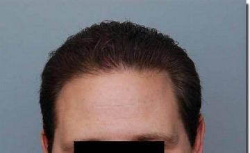 Hair restoration procedure results