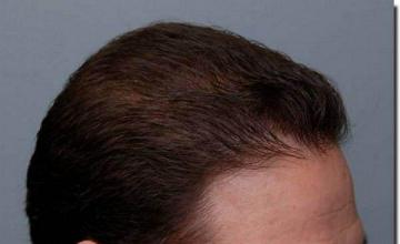 Hair restoration procedure results