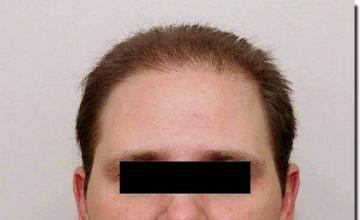 Hair restoration procedure results