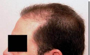 Hair restoration procedure results