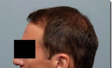 Hair restoration procedure results