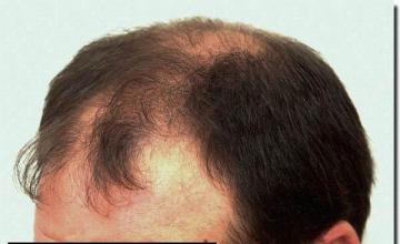 Hair restoration procedure results