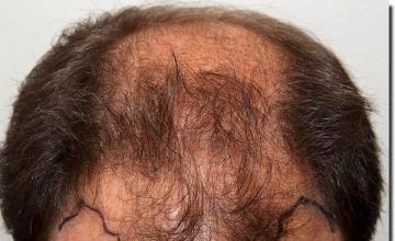 Hair restoration procedure results