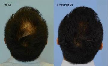 Hair transplantation surgery before and after pictures