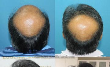 Hair restoration procedure before and after images