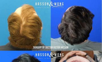 Surgical hair transplantation result photographs