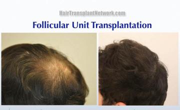 Hair restoration procedure before and after pictures