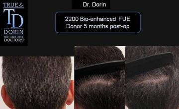 Hair restoration procedure before and after pictures