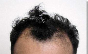 Hair restoration procedure results