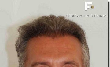 Hair restoration procedure results