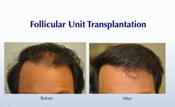 Hair transplantation surgery before and after pictures