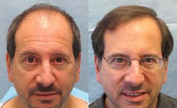 Hair restoration procedure before and after results