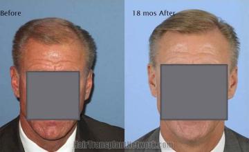 Front view - Before and 18 months after hair restoration surgery