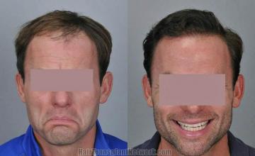 Before and after hair transplant procedure images