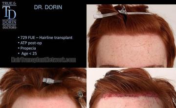 Before and after hair transplant procedure images