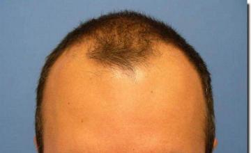 Hair restoration procedure results