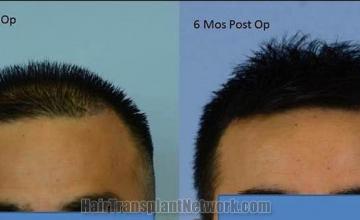 Hair restoration procedure before and after results