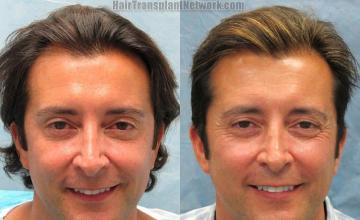 Hair transplant surgery before and after pictures